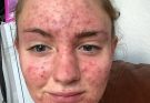 HT10. Her body was itching, thought it was an allergy but they diagnosed ca…