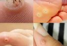 Be Very Careful: If You Notice This Skin Growth, It Could Be Serious